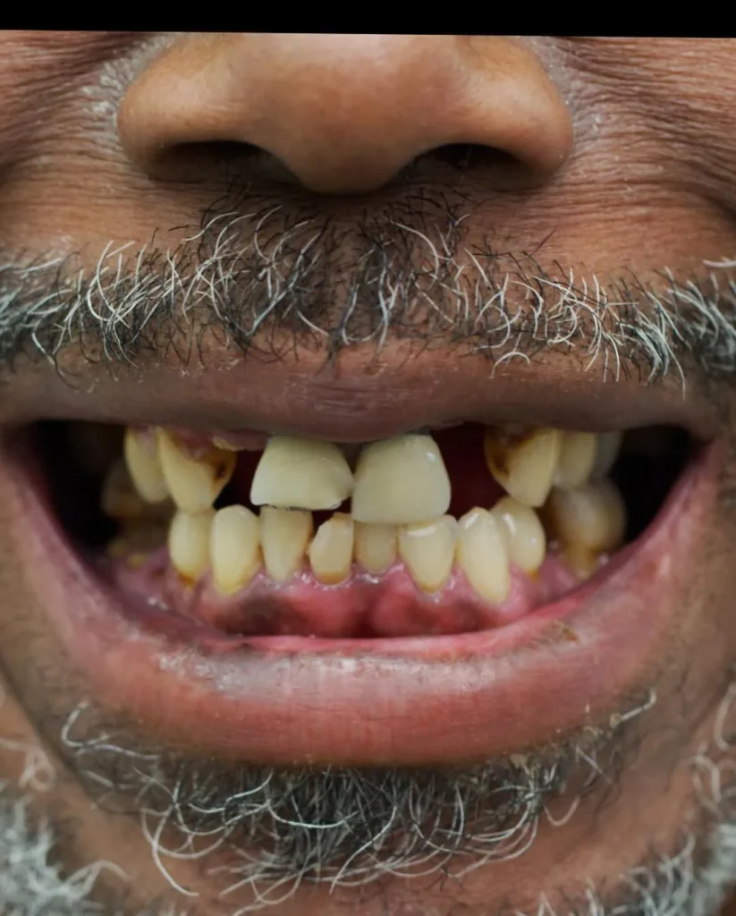 Before: failing dentition