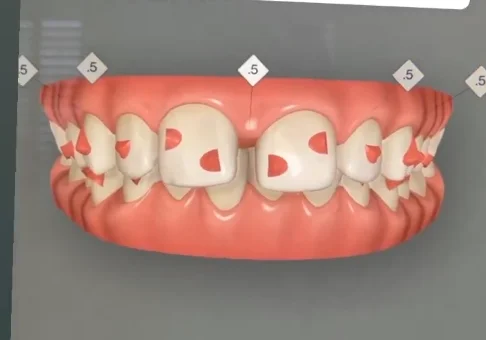 Digital smile design